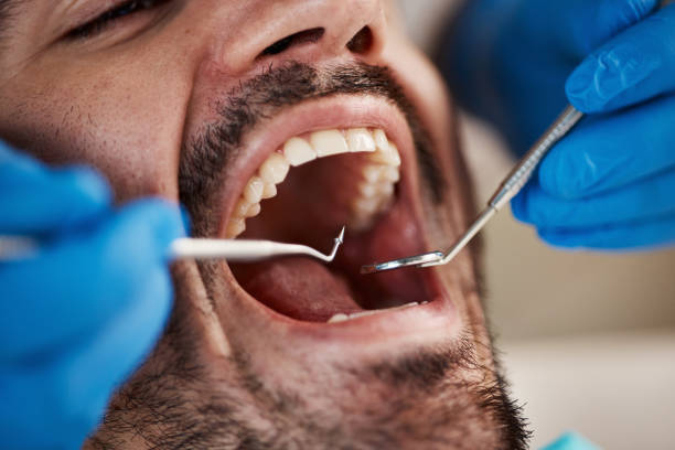 Best Emergency Wisdom Tooth Extraction in St Helena, CA